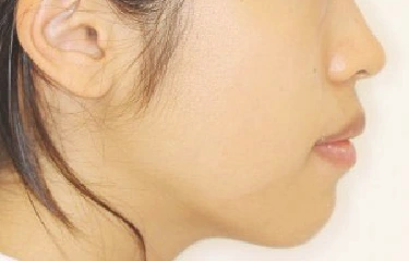 歯列矯正・ワイヤー矯正（表側）の治療後 ｜ 野村矯正歯科クリニック