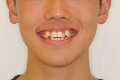 歯列矯正・マウスピース矯正の治療前（正面） ｜ 野村矯正歯科クリニック