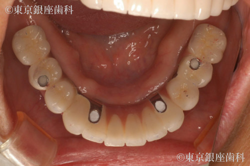 インプラント・多数歯欠損インプラントの治療後 ｜ 東京銀座歯科