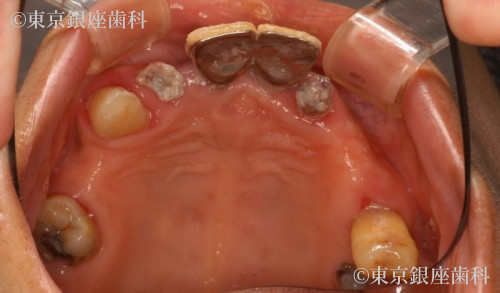 インプラント・多数歯欠損インプラントの治療前 ｜ 東京銀座歯科