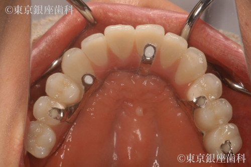 インプラント・多数歯欠損インプラントの治療後 ｜ 東京銀座歯科